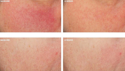 Visible skin improvement comparison at 8 weeks using SkinCeuticals Glycolic 10 Renew Overnight night exfoliating treatment.