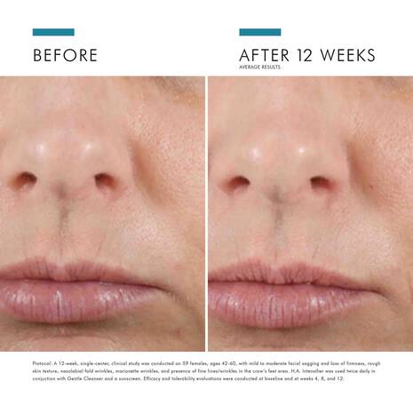 Before and after 12 weeks of SkinCeuticals Hyaluronic Acid Intensifier showing improved skin texture and hydration