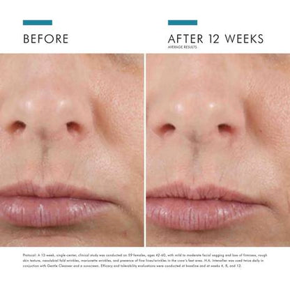 Before and after 12 weeks of SkinCeuticals Hyaluronic Acid Intensifier showing improved skin texture and hydration