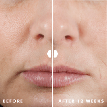 Before and after results using SkinCeuticals Hyaluronic Acid Intensifier over 12 weeks