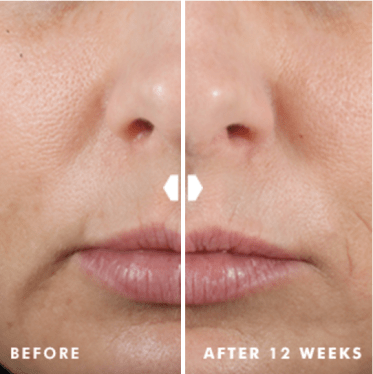 Before and after 12 weeks of using SkinCeuticals Hydrating B5 Gel, showing smoother and more hydrated skin