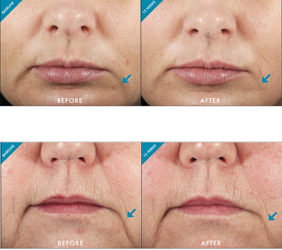 Before and after results of SkinCeuticals Metacell Renewal B3 showing reduced fine lines and improved skin