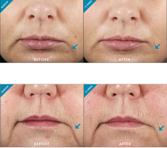 Clinical proven before and after grid showing smoother skin texture after using SkinCeuticals Metacell Renewal B3
