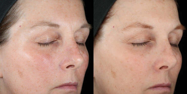 Before and after showing improved texture, tone, and firmness with SkinCeuticals Metacell Renewal B3 serum