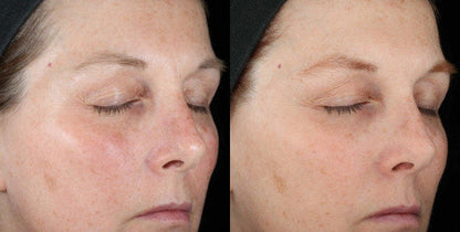 Before and after of SkinCeuticals Metacell Renewal B3 showing improved skin texture and reduced redness