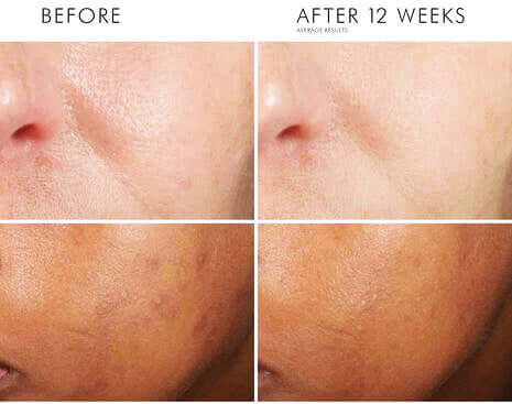 Before and after 12 weeks photo showing brighter, more even skin tone after using SkinCeuticals Phloretin CF serum for glow