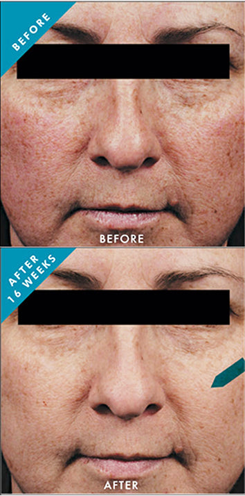 Before and after using SkinCeuticals Phloretin CF for 16 weeks, showing reduced dark spots, wrinkles, and improved skin