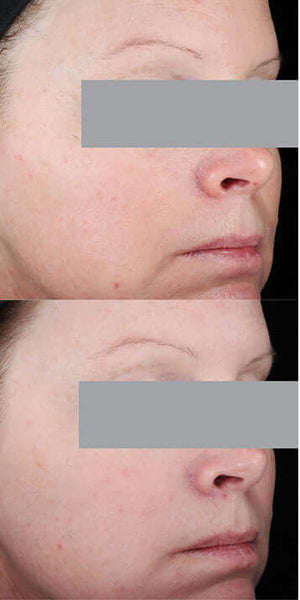 Before and after comparison showing anti-aging results from nightly use of Skinceuticals Resveratrol B E antioxidant serum.