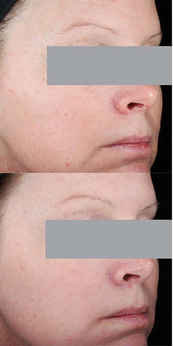 Before and after comparison showing anti-aging results from nightly use of Skinceuticals Resveratrol B E antioxidant serum.