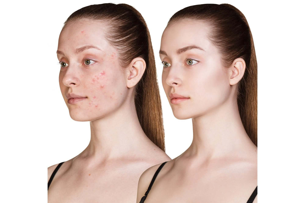 Before and after showing clearer skin after using SkinCeuticals Silymarin CF serum for oily skin