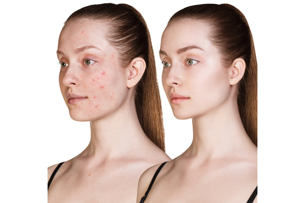 Before and after image showing acne improvement and clearer skin after using SkinCeuticals Silymarin CF antioxidant serum