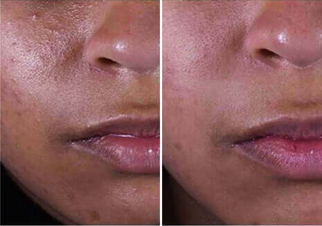 Before and after results showing improved skin clarity and reduced breakouts with SkinCeuticals Silymarin CF vitamin C serum.