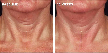 Before and after of SkinCeuticals Tripeptide-R Neck Repair showing reduced neck wrinkles and firmer skin