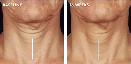 Before and after of SkinCeuticals Tripeptide-R Neck Repair showing firmer skin and reduced neck lines after 16 weeks