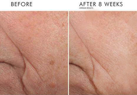 Before and after using SkinCeuticals Triple Lipid Restore for 8 weeks, showing reduced wrinkles and improved skin texture.