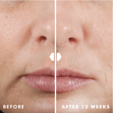 skinceuticals hyaluronic acid intensifier before and after