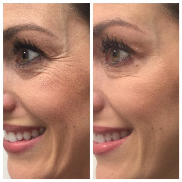 Before and after of SkinMedica Dermal Repair Cream showing reduced fine lines and improved hydration around the eye area