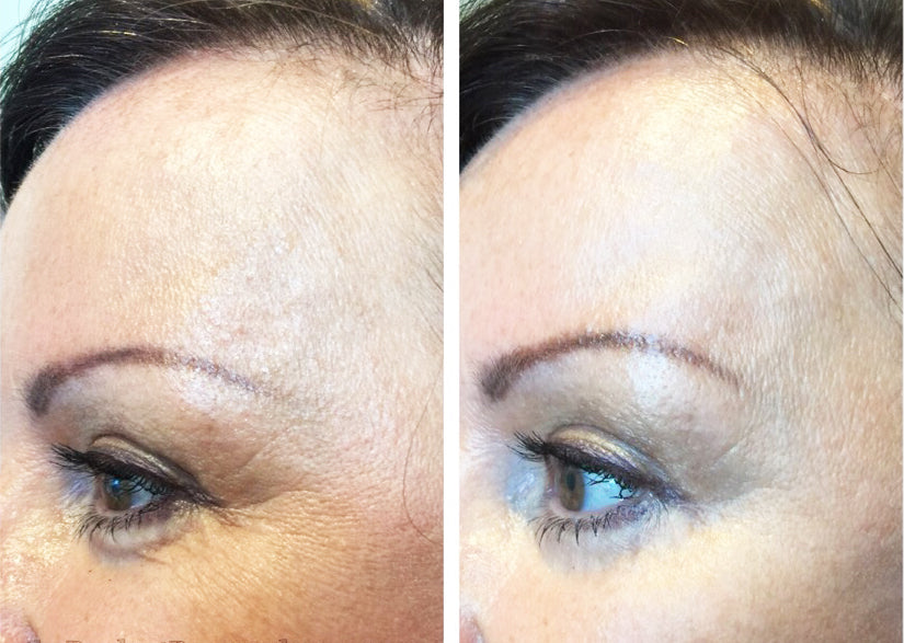 Before and after of SkinMedica HA5 Rejuvenating Hydrator showing improved skin hydration, smoothness, and reduced fine lines