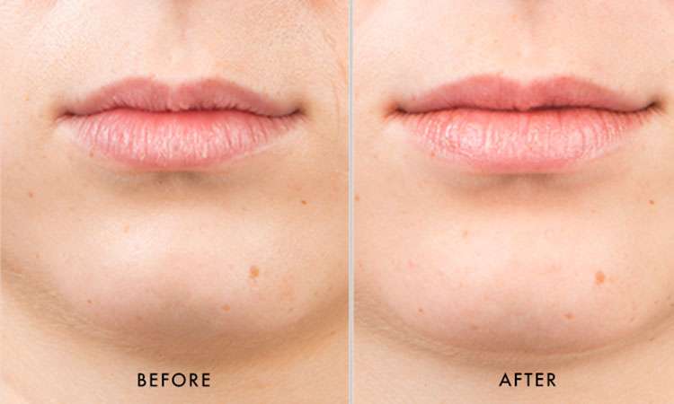 Before and after of SkinMedica HA5 Smooth & Plump Lip System showing fuller, smoother lips with improved hydration