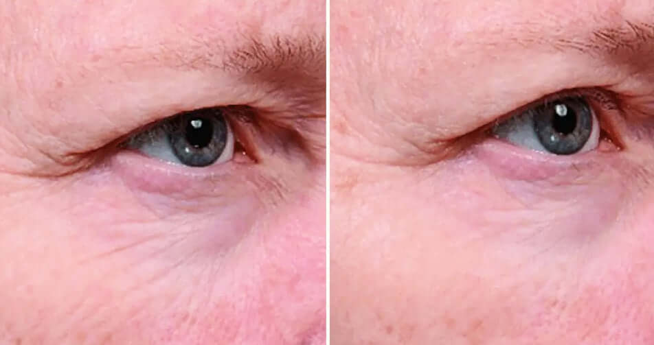 SkinMedica Instant Bright Eye Cream before and after image showing smoother under-eye skin with less visible puffiness