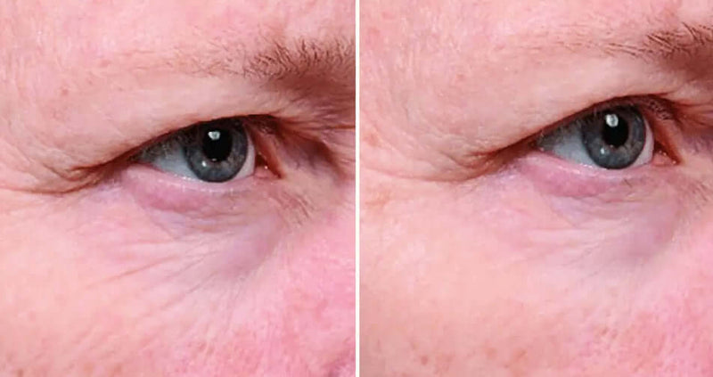 SkinMedica Instant Bright Eye Cream before and after image showing smoother under-eye skin with less visible puffiness