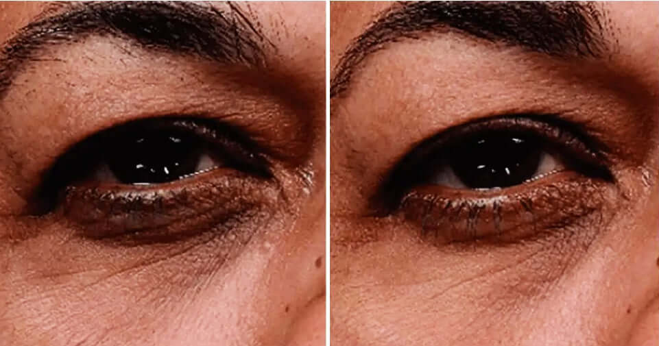 SkinMedica Instant Bright Eye Cream before and after image showing brighter under-eye skin and reduced dark circle look now.