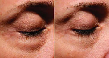 SkinMedica Instant Bright Eye Mask before and after image showing brighter under-eye skin and reduced tired dark circle look