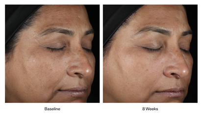 Before and after of SkinMedica LUMIVIVE System showing improved skin radiance and even skin tone after 8 weeks of use