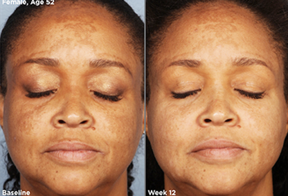 Before and after of SkinMedica LUMIVIVE System showing improved skin tone and radiance after 12 weeks of use