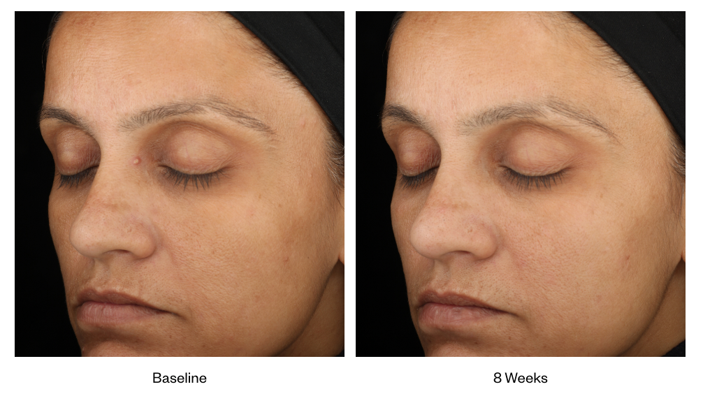 Before and after of SkinMedica LUMIVIVE System showing improved skin tone and reduced dullness after 8 weeks of use