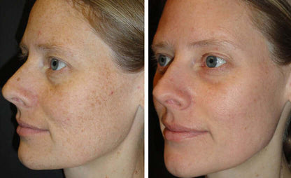SkinMedica Rejuvenative Moisturizer before after image showing smoother hydrated skin texture and radiance daily