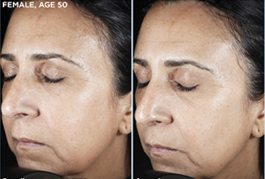 Before and after of SkinMedica Rejuvenative Moisturizer showing improved hydration and smoother skin texture