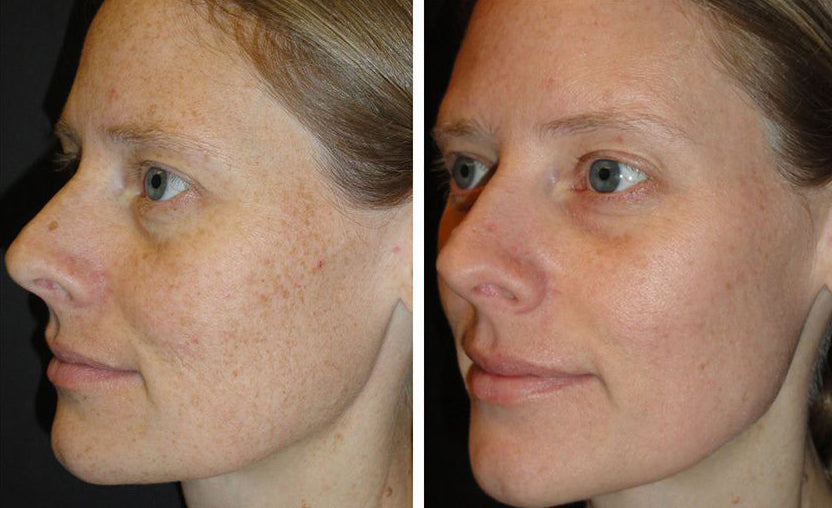 Before and after of SkinMedica Rejuvenative Moisturizer showing improved skin hydration and texture