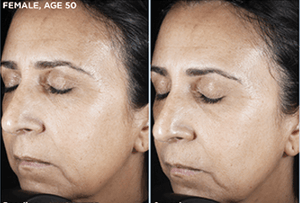 SkinMedica Rejuvenative Moisturizer before after image showing improved hydration and smoother skin texture