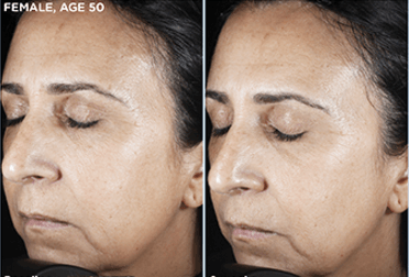 SkinMedica Rejuvenative Moisturizer before after image showing improved hydration and smoother skin texture
