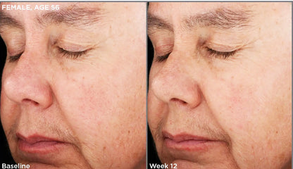 Before and after of SkinMedica Retinol Complex 0.5 showing reduced wrinkles and smoother skin texture after 12 weeks