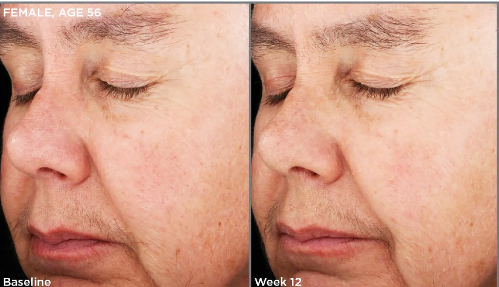 Before and after of SkinMedica Retinol Complex 0.5 showing reduced wrinkles and smoother skin texture after 12 weeks