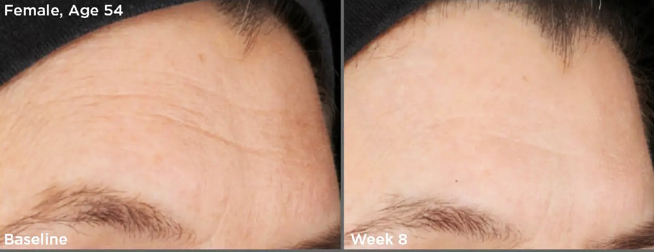 Before and after of SkinMedica Retinol Complex 0.5 showing reduced forehead wrinkles and smoother skin after 8 weeks