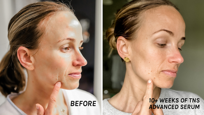 Before and after of SkinMedica TNS Advanced+ Serum showing improved skin texture and reduced fine lines after 10 weeks