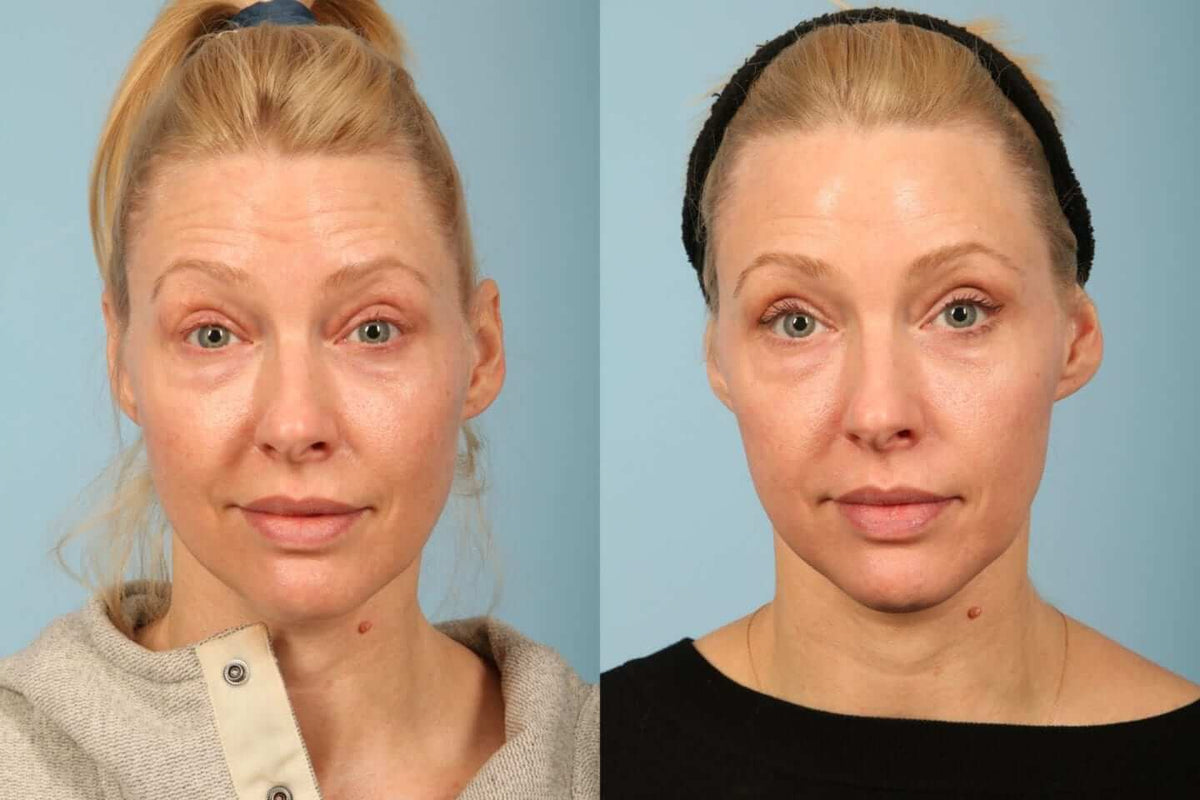 SkinMedica TNS Advanced+ Serum before and after image showing smoother-looking skin, improved firmness, and radiant tone now