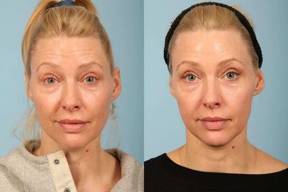 SkinMedica TNS Advanced+ Serum before and after image showing smoother-looking skin, improved firmness, and radiant tone now