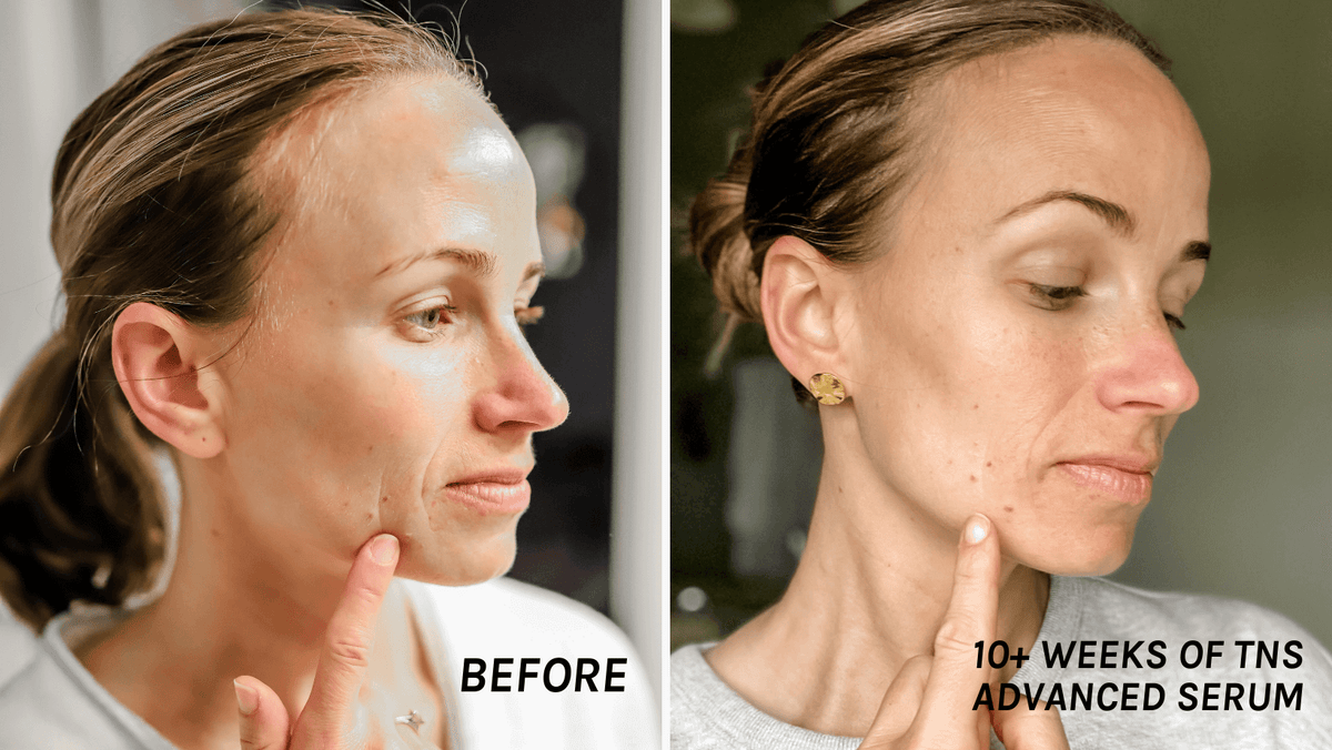 SkinMedica TNS Advanced+ Serum before and after image showing visible improvement after ten weeks of daily skincare use now.