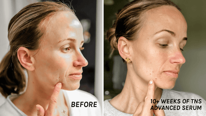 SkinMedica TNS Advanced+ Serum before and after image showing visible improvement after ten weeks of daily skincare use now.