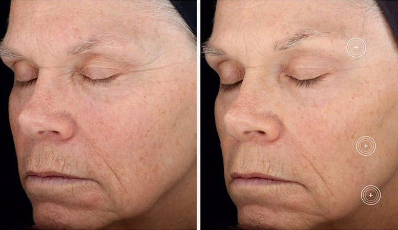 Before and after of SkinMedica TNS Recovery Complex showing reduced wrinkles, improved skin texture, and smoother complexion