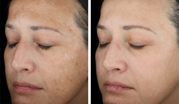 Before and after of SkinMedica TNS Recovery Complex showing reduced hyperpigmentation and improved skin texture