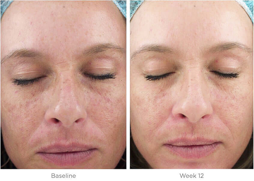 SkinMedica Ultra Sheer Moisturizer before after 12 week skin result showing improved texture and smoother tone visibly