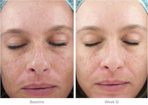 SkinMedica Ultra Sheer Moisturizer before after 12 week skin result showing improved texture and smoother tone visibly