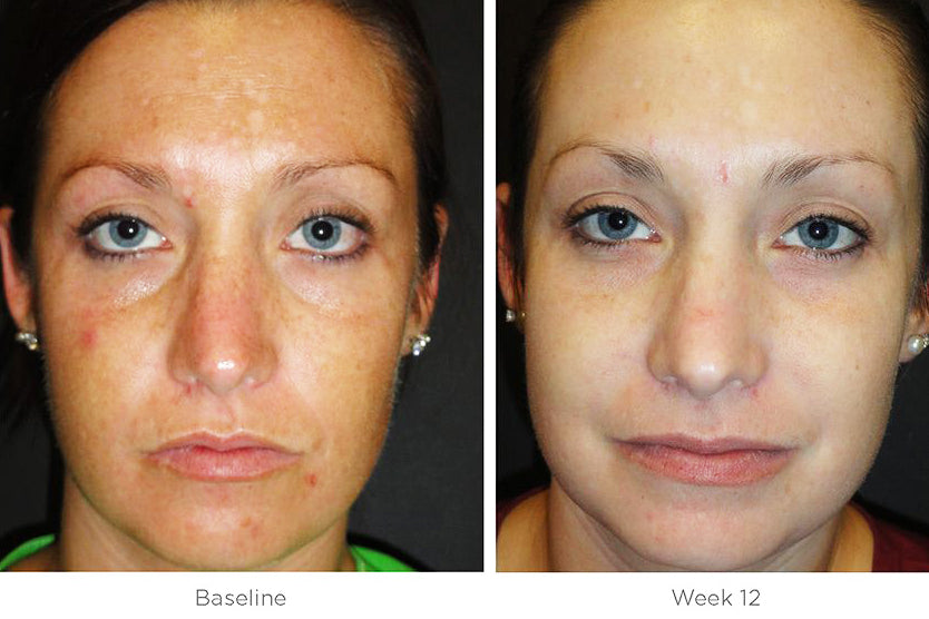 Before and after of SkinMedica Ultra Sheer Moisturizer showing improved skin texture, hydration, and clarity after 12 weeks