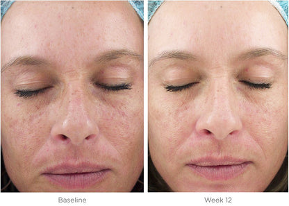 Before and after of SkinMedica Ultra Sheer Moisturizer showing improved hydration and skin texture after 12 weeks of use