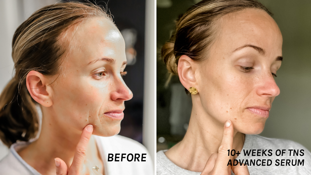 skinmedica tns advanced serum before and after